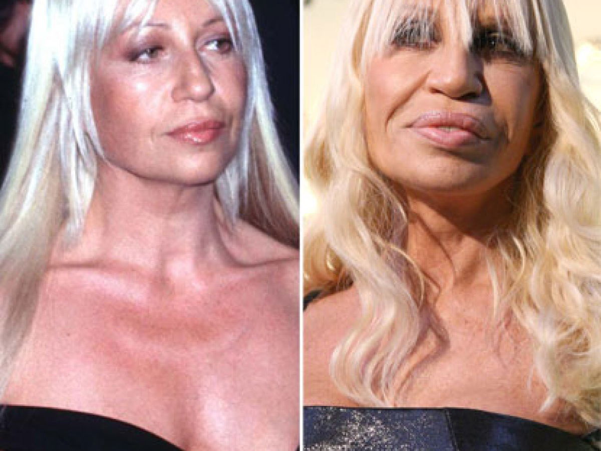 10 epic celebrity plastic surgery disasters