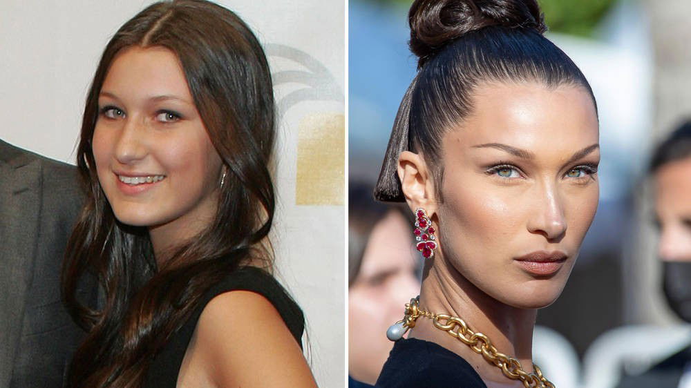 Bella Hadid Eye Surgery, Forehead, Nose, Hair, Skin, Lip, Chin, Hairstyle, Eyebrow, Smile, Eyelash