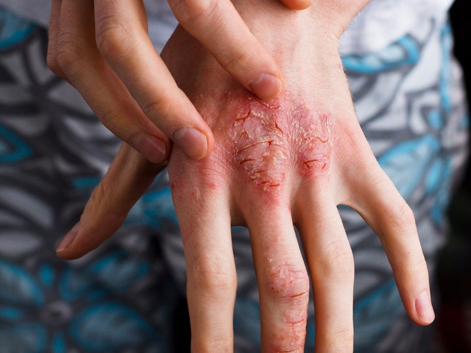 5 Most Common Atopic Dermatitis Causes You Should Be Aware Of